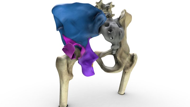 Posterior Wall Acetabulum Fracture 3D Model