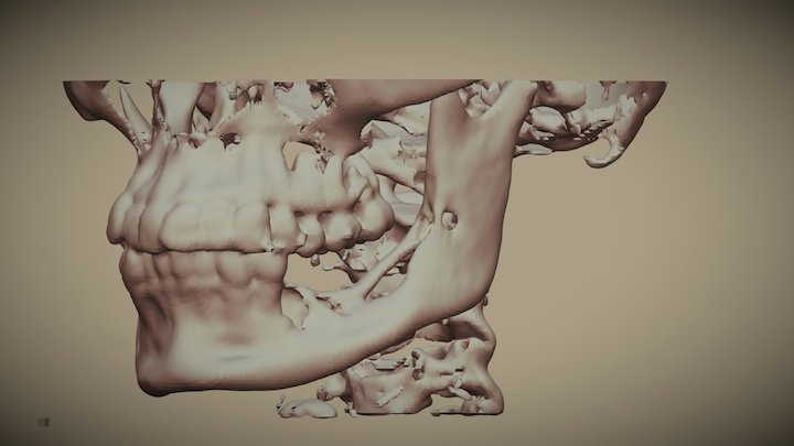 Maxilares - Ameloblastoma postquirurgico 3D Model