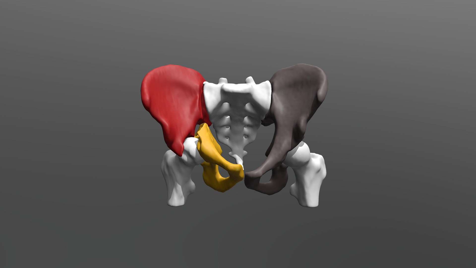 Transverse acetabular fracture. - 3D model by valchanov [2c989cd ...