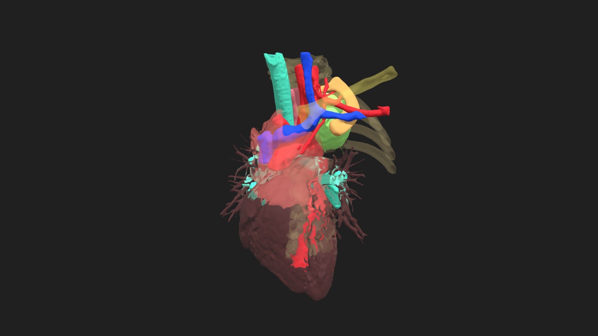 Tumor in subclavian region - 3D model by thorac.topsurgery [2ca5998 ...