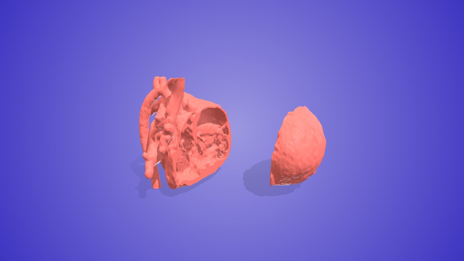 Atrial Ventricular Septal Defect (AVSD)