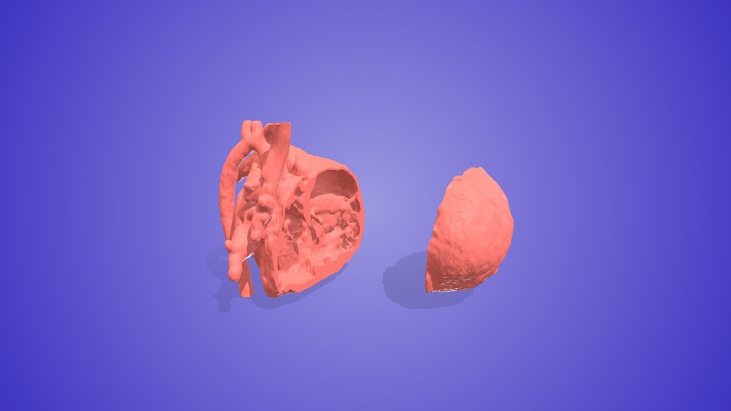 Septal Defects - A 3D model collection by 3D Heart Project ...