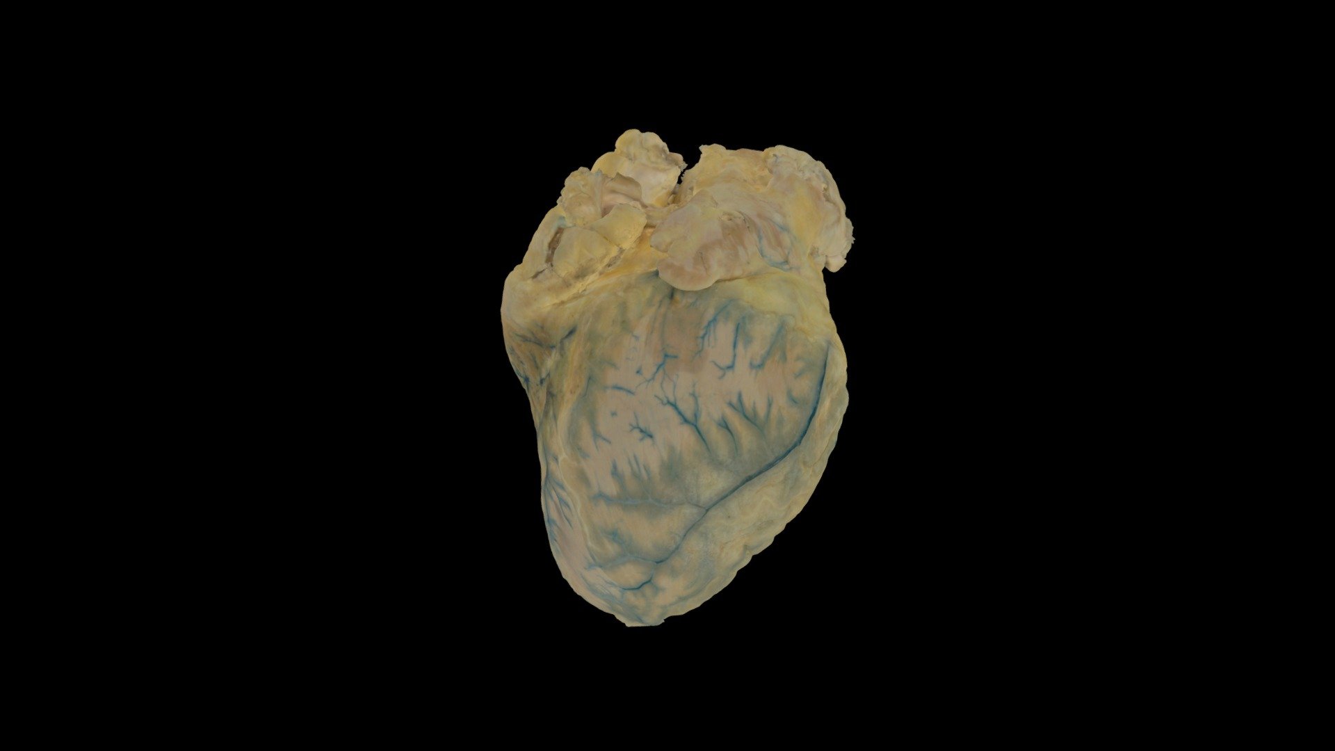Human Heart with Coronary Contrast #0084