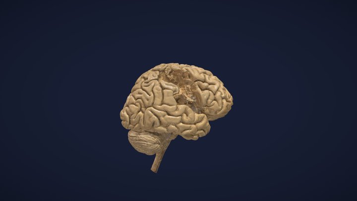 Gehirn Schlaganfall plastiniert/ brain Stroke 3D Model