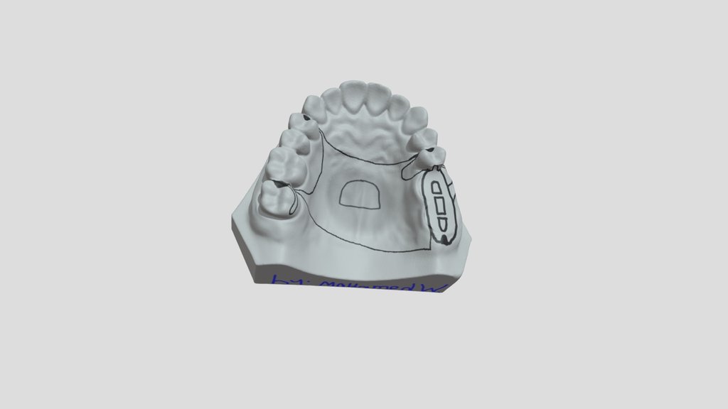 class II maxillary arch by mohamed waad.