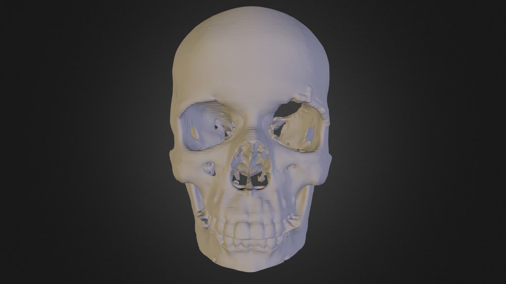 Anterior Skull Section with tumor removed.
