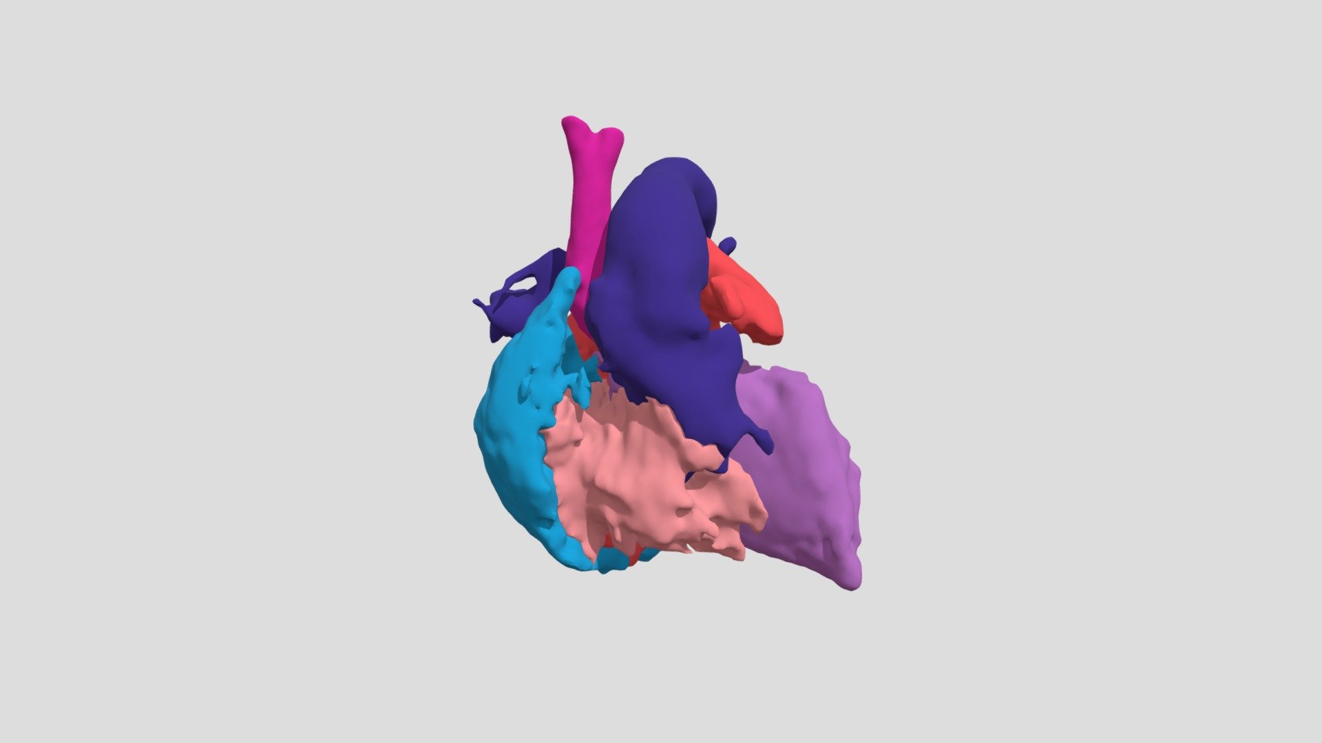 Interrupted Aortic Arch and VSD (S0373) - 3D model by NCHS Cardiac ...