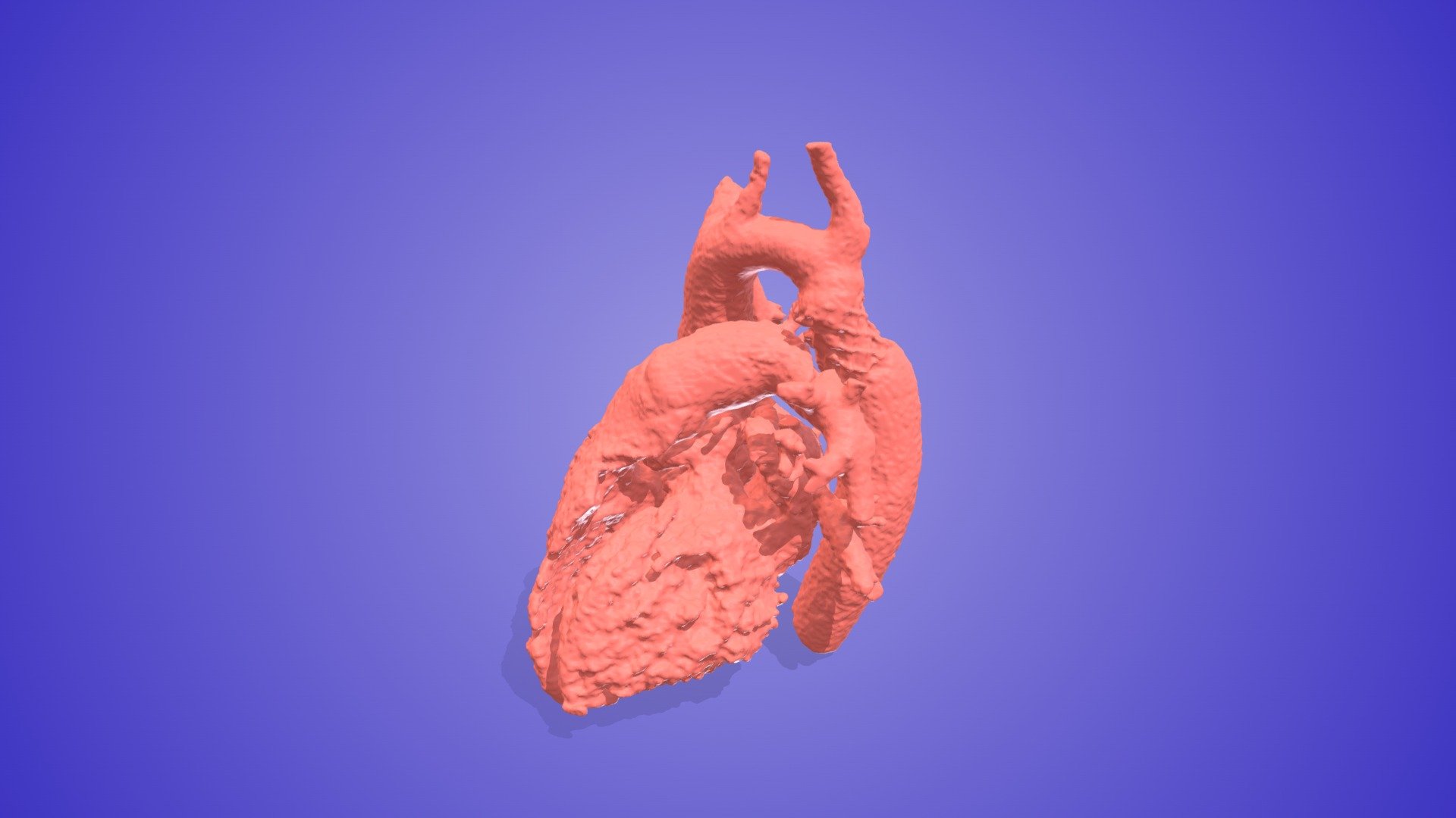 Repaired Coarctation of the Aorta