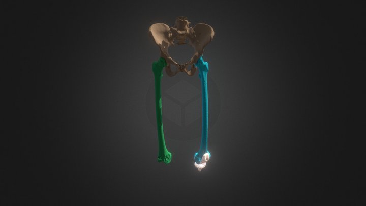 Femur Segmentation 3D Model
