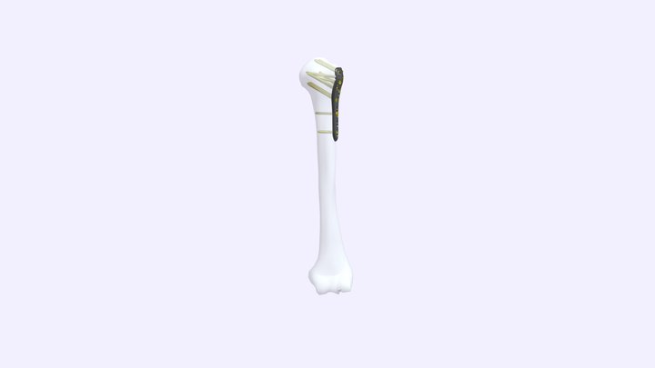 Anatomic Proximal humerus plate (A-PHP) 3D Model