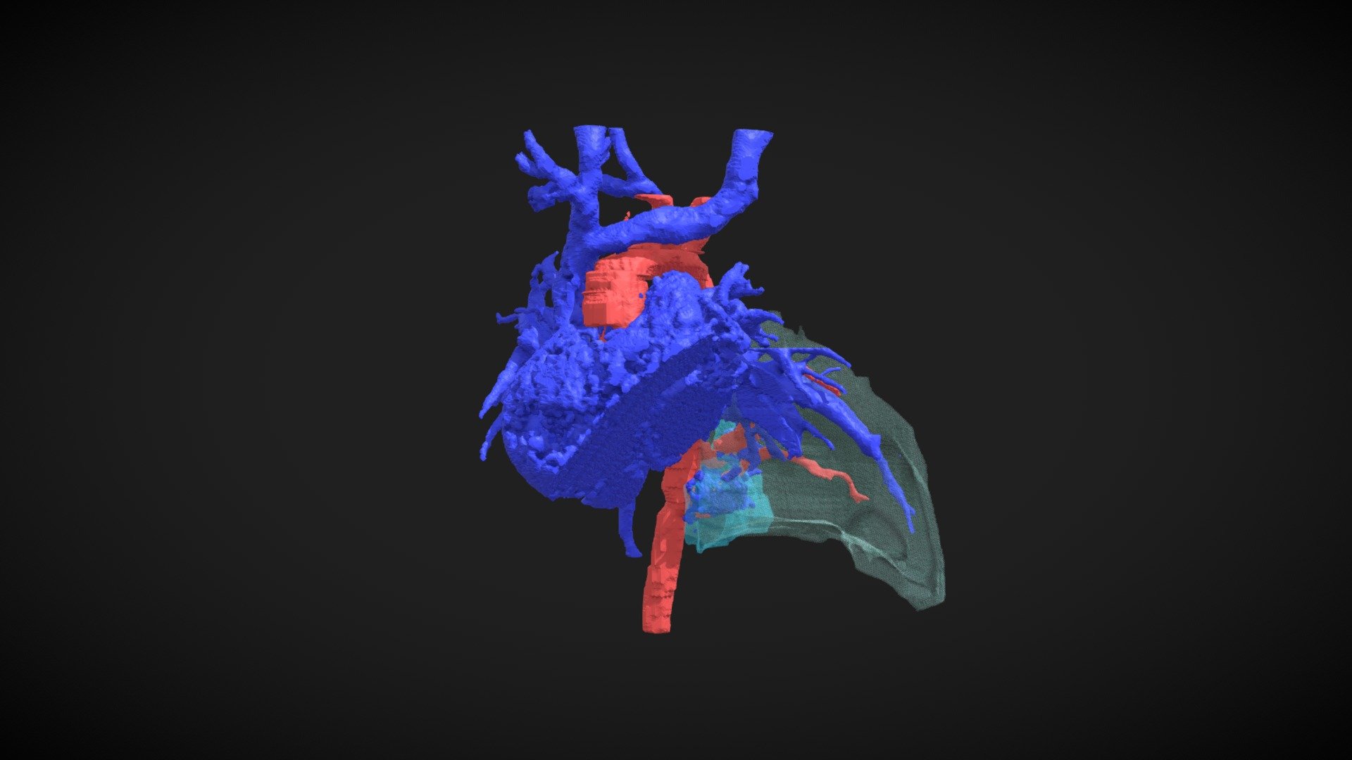 Pulmonary Sequestration - 3D model by Lincoln Wong (@lincolnwong ...