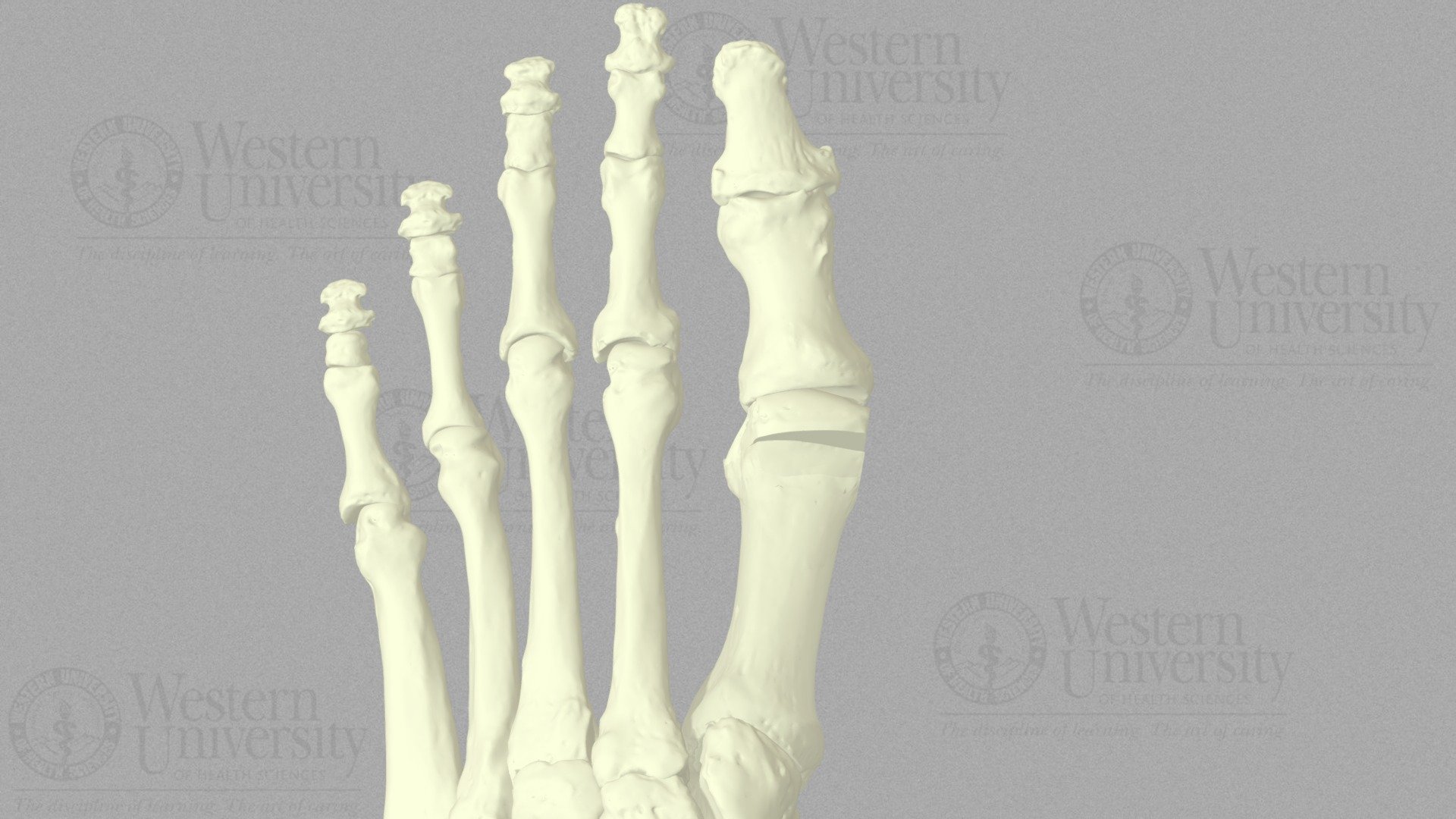 Reverdin Osteotomy D Model By Westernu D B Sketchfab