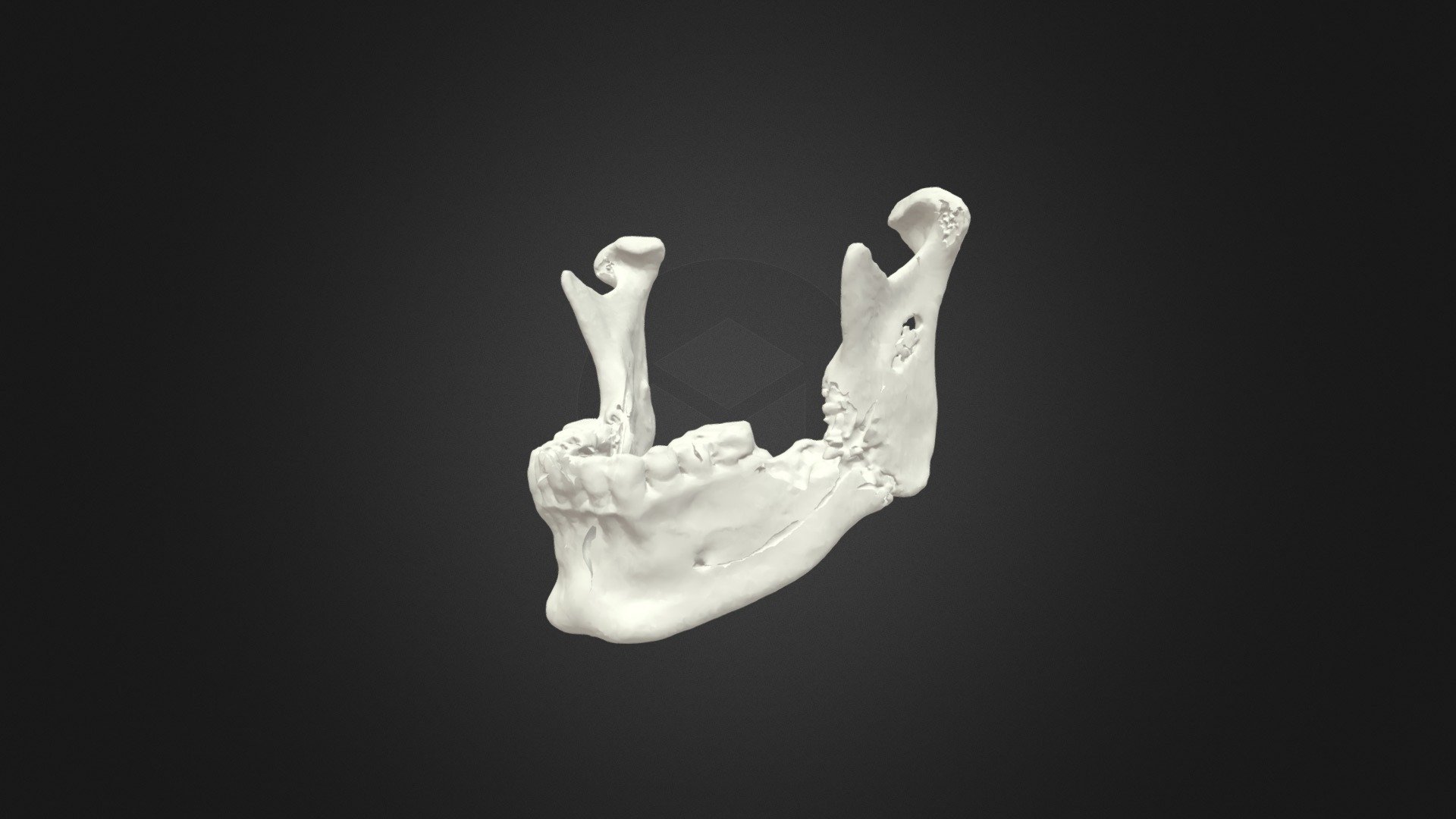 Mandibular Osteonecrosis and Fracture - 3D model by yuhuihuang [305bf5f ...