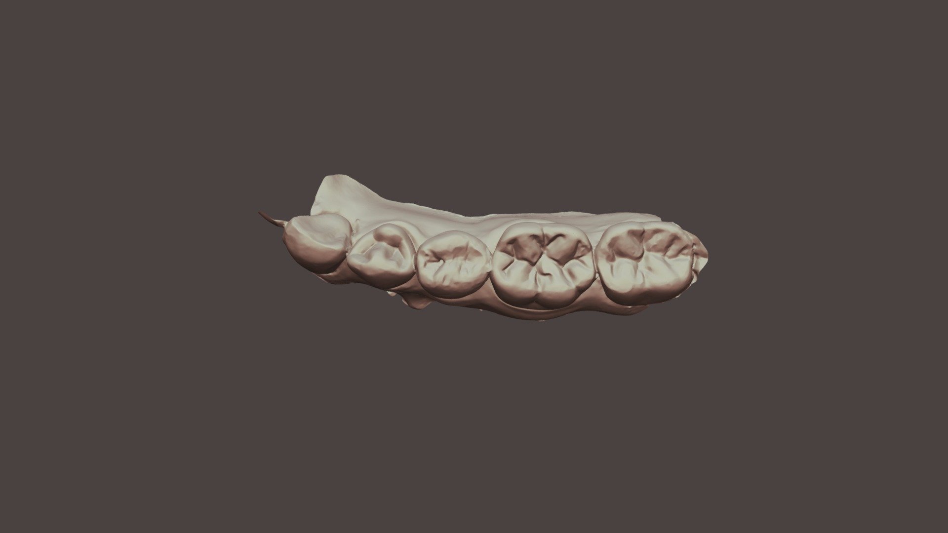 Group 14 Tooth #20-2