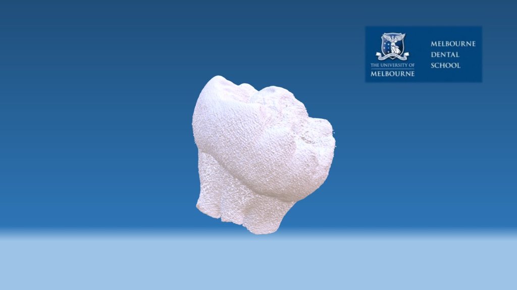 developing third molar (wisdom tooth)