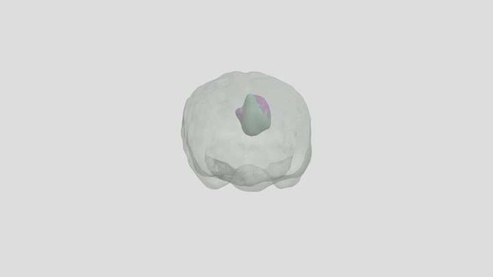 Tumors 2025 3D Model