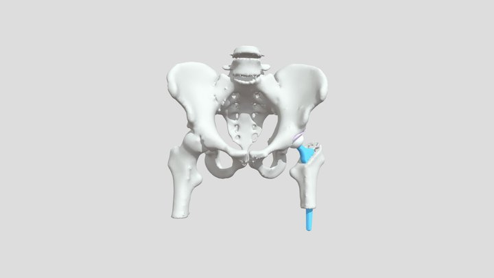 Virtuelle Planung eines künstlichen Hüftgelenkes 3D Model