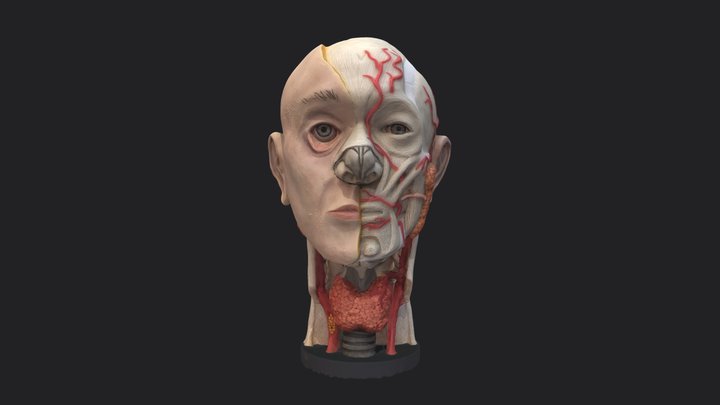 Symptoms of Hypothyroidism 3D Model