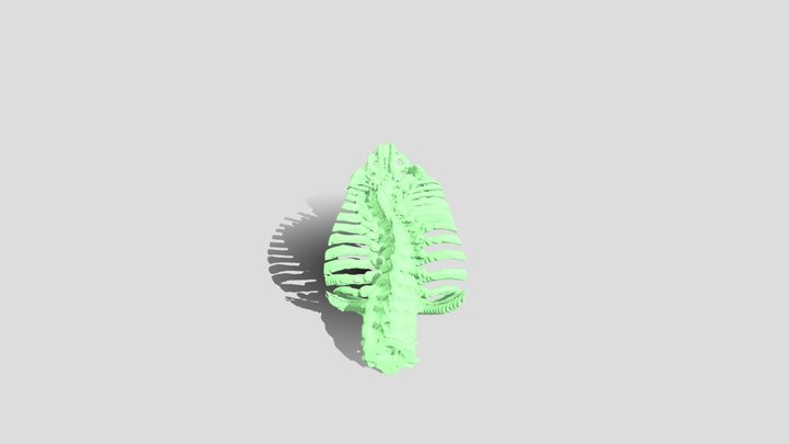 Severe Scoliosis 3D Model
