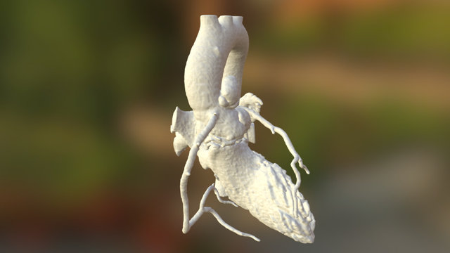 Doppelaneurysma 3D Model