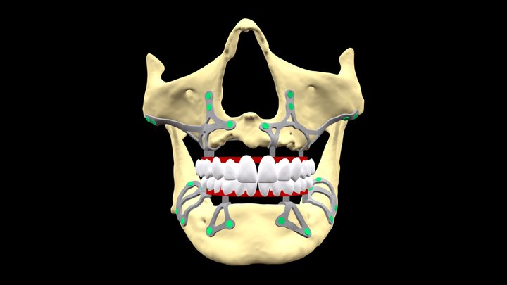 Total Rehabilitation - Subperiosteal Implants 3D Model