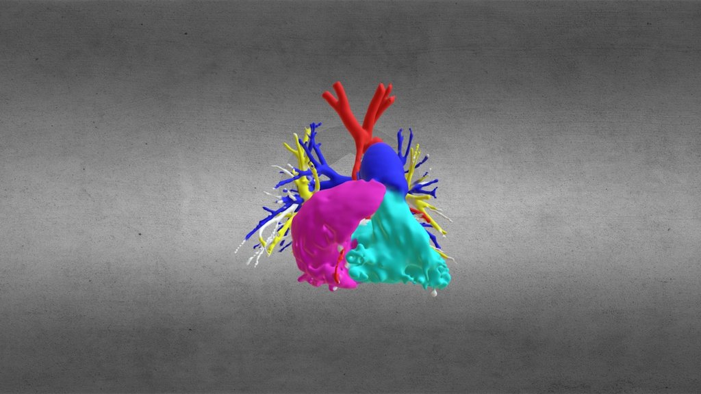 Hypoplastic Left Heart