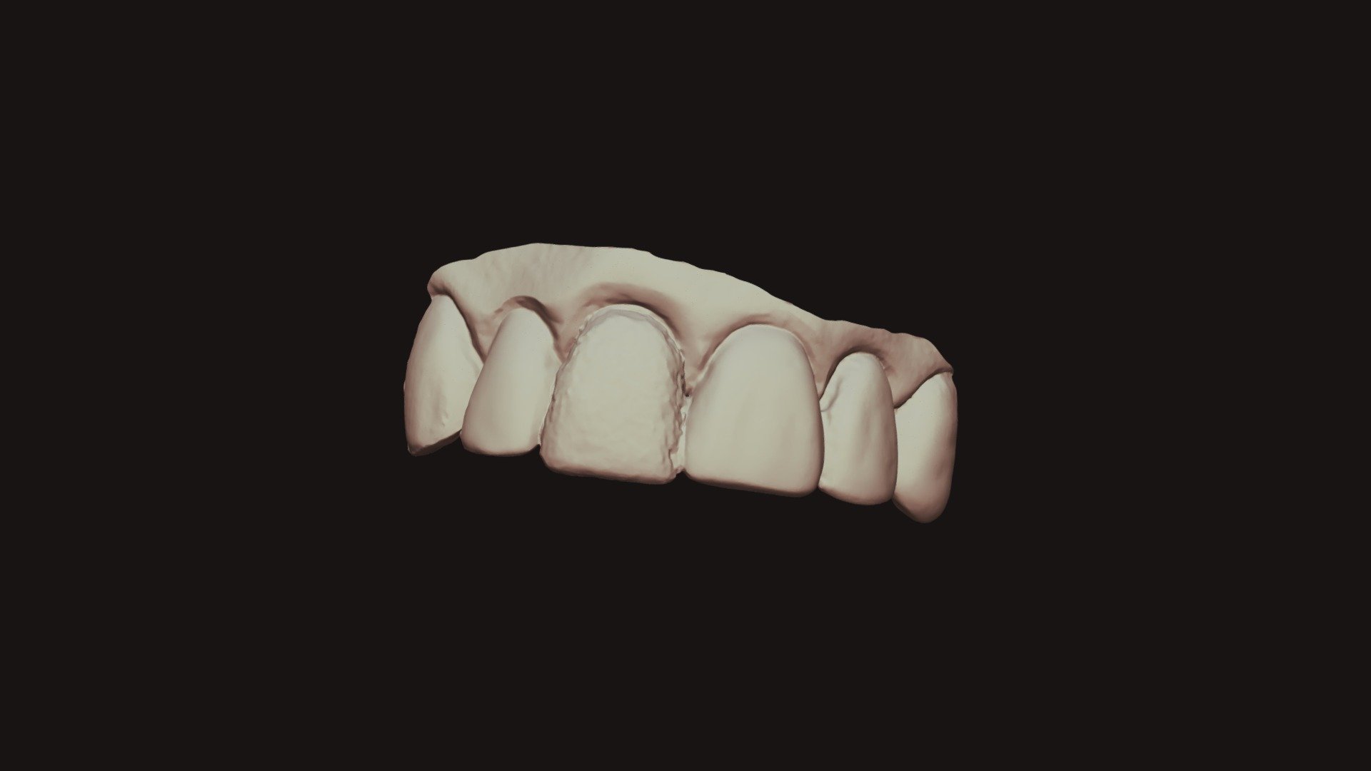 Group #5 Tooth 8 Wax (2)
