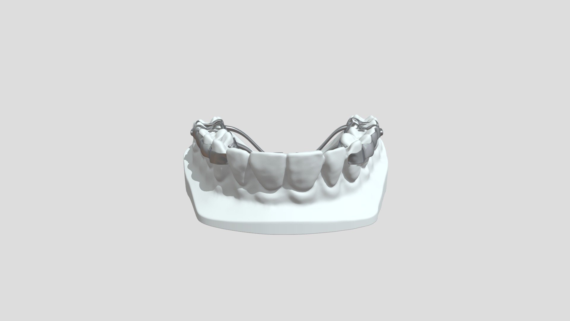 Leaf Spring Activated Expander - 3D model by ODL OrthoLab (@Odlortho ...