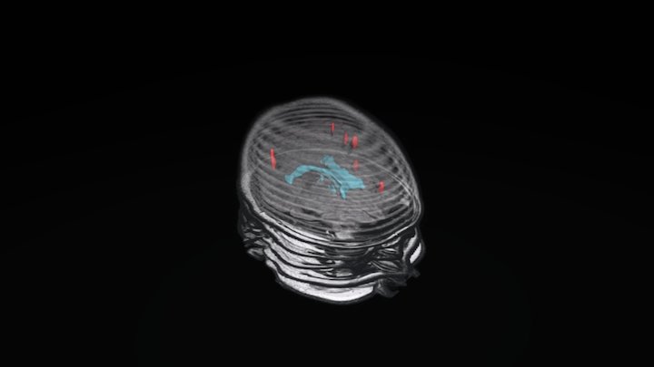 3D of head based on axial FLAIR images 3D Model