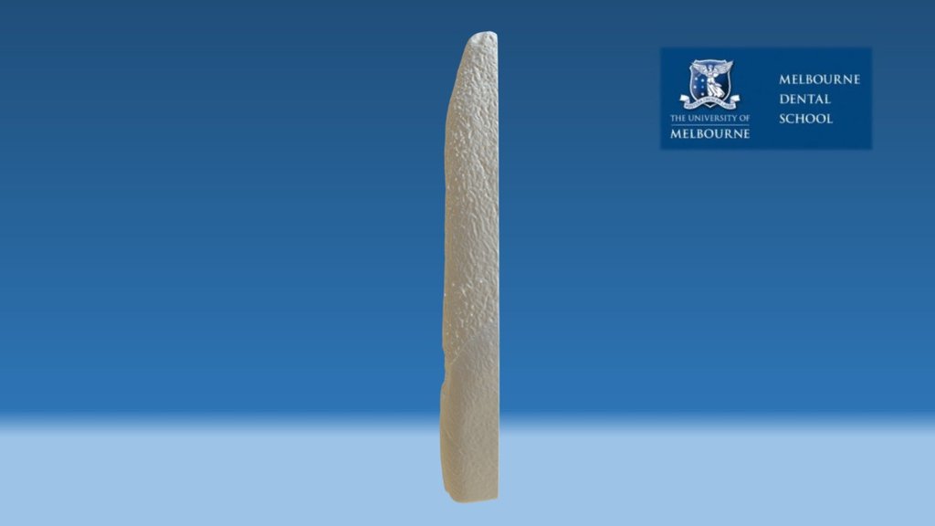 Bisected upper central incisor