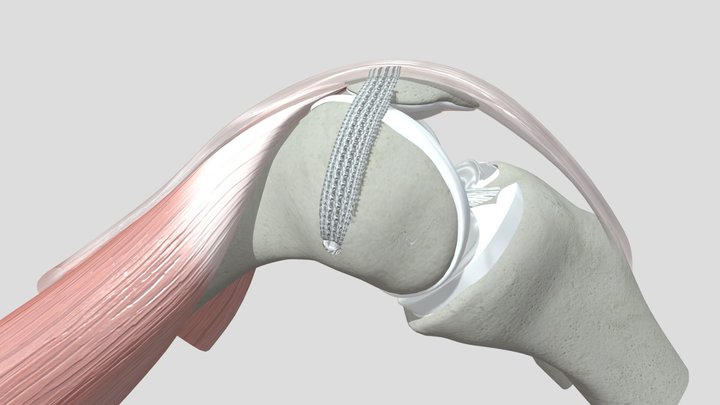 MPFL Technique using 10 mm Poly-Tape 3D Model
