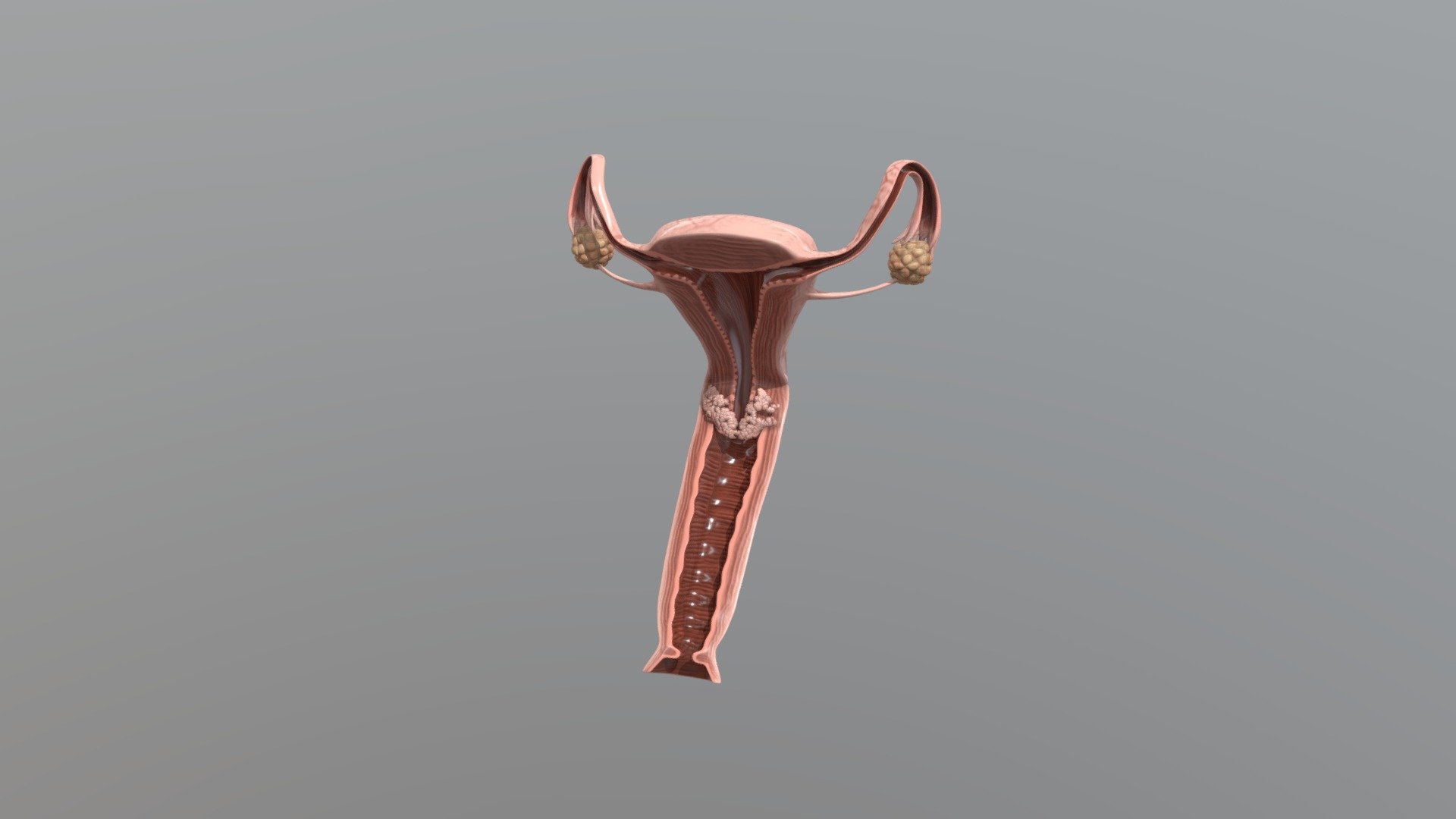 Kanker Rahim - 3D model by animas.penyakit.wanita.4 [34c5553] - Sketchfab