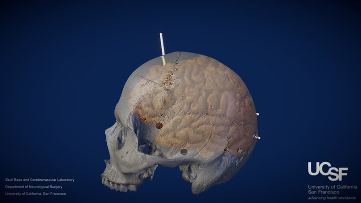 CPs - Model 7: Keyholes and Ventricular Accesses – Free 3D Model STL