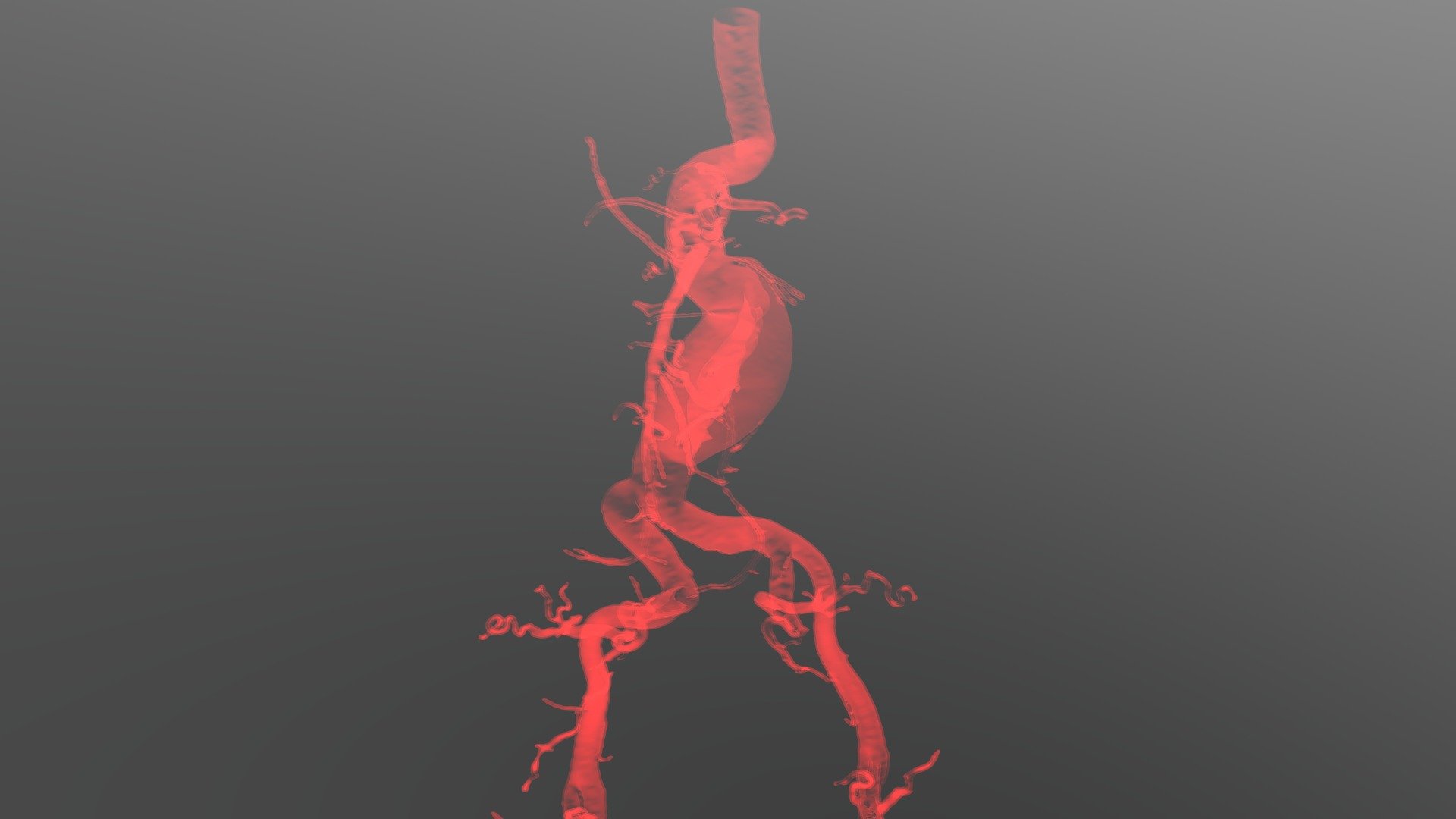 Abdominal aortic aneurysm - 3D model by valchanov [35a76ad] - Sketchfab