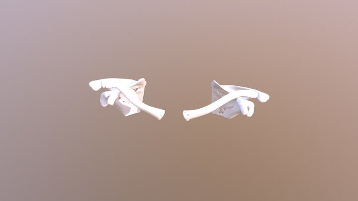 Clavicule Fracture - healed 3D Model