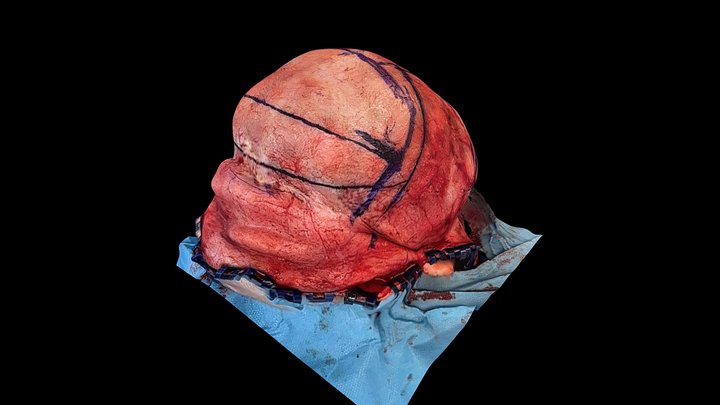 Late Scaphocephaly with frontal bossing (Preop) 3D Model