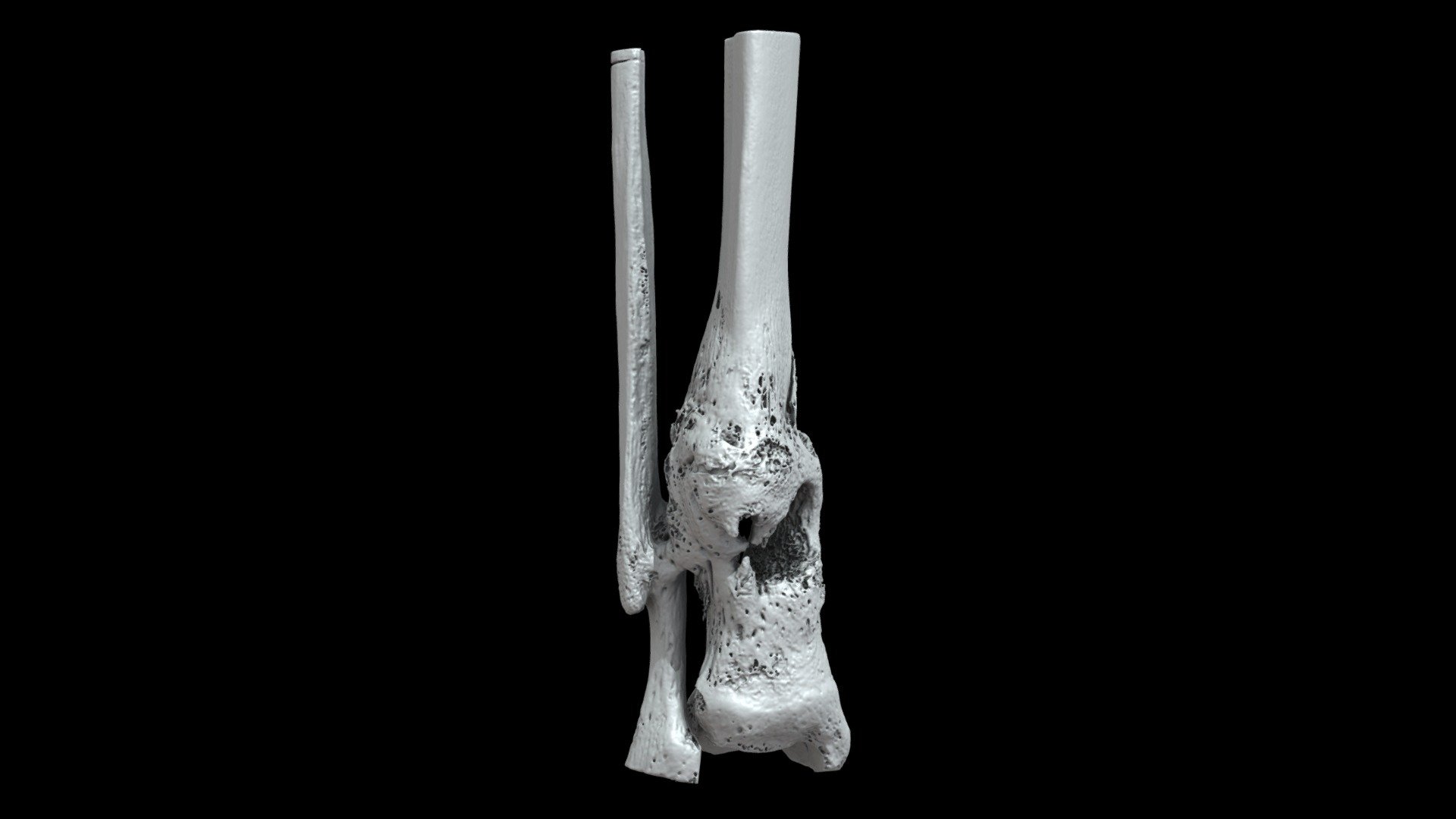 Tibia/Fibula with Osteomyelitis (VCU_3D_5442) - 3D model by Virtual ...