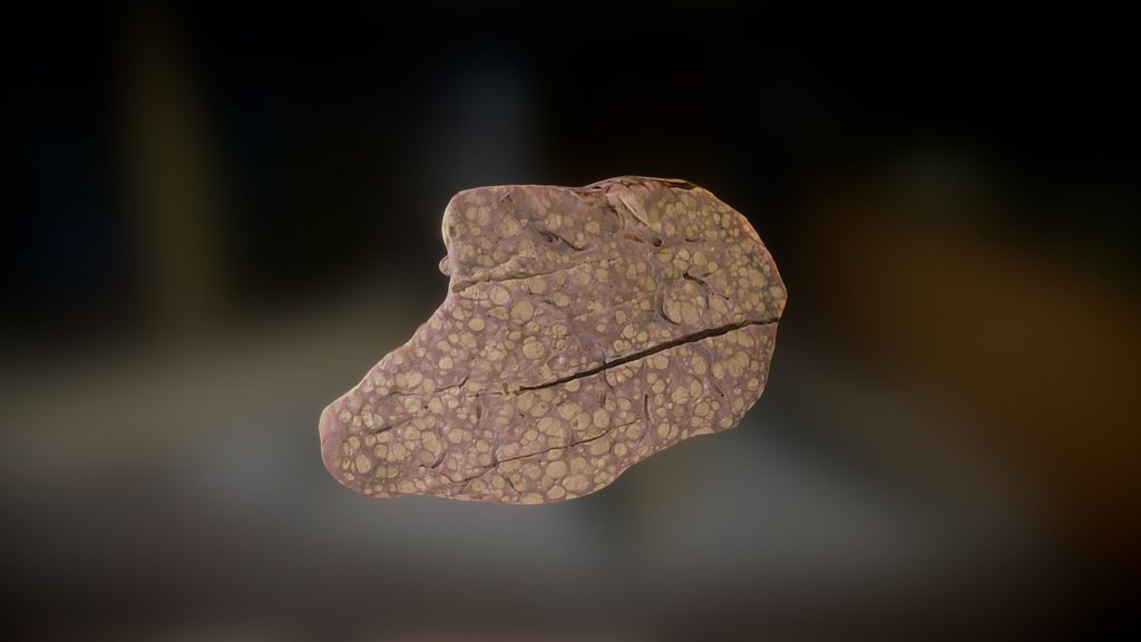 Cirrhosis from Hep C liver