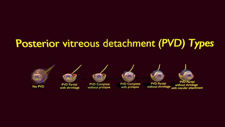 Vitreous detachment types posterior prolapse 3D Model