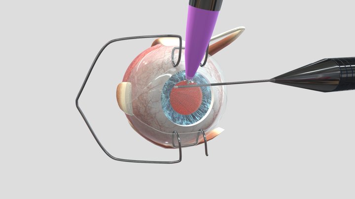 Cataract Surgery Animation 3D Model
