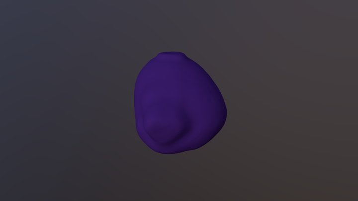 Aneurysm 3D Model
