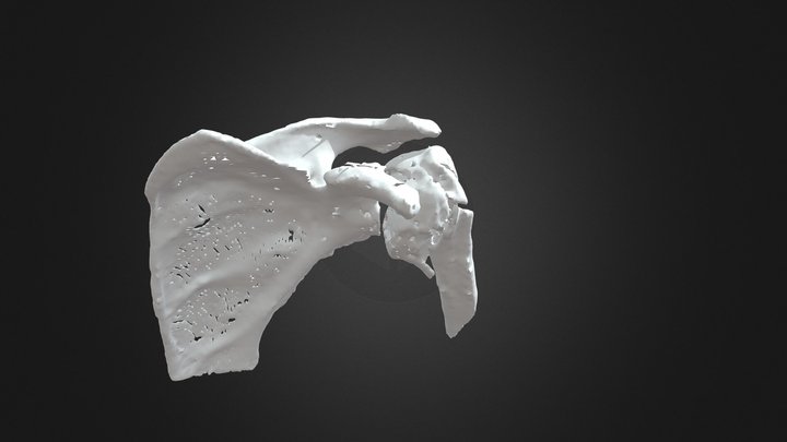 Proximal humerus fracture 3D Model