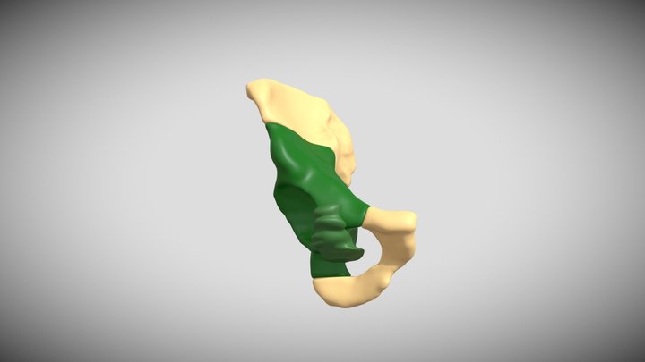PELVIStumorSINfemur 3D Model