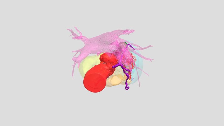 Prosthetic Ao valve IE with pseudoaneurysm 3D Model