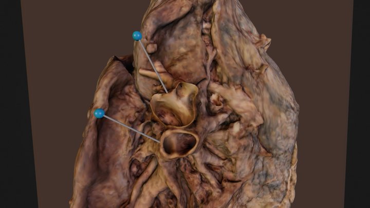 Left lung with stick pins 3D Model