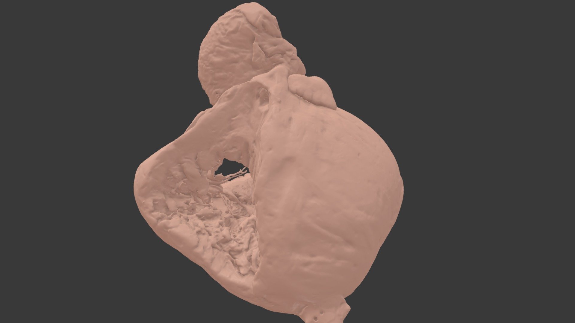 VSD #9 - Canal type VSD, PA - 3D model by heartmodels [3993621] - Sketchfab