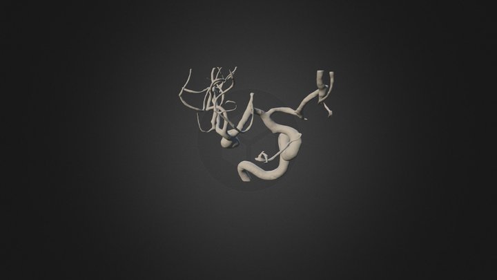 Right ICA (MCA Aneurysm And Fenestrated ACOM) 3D Model