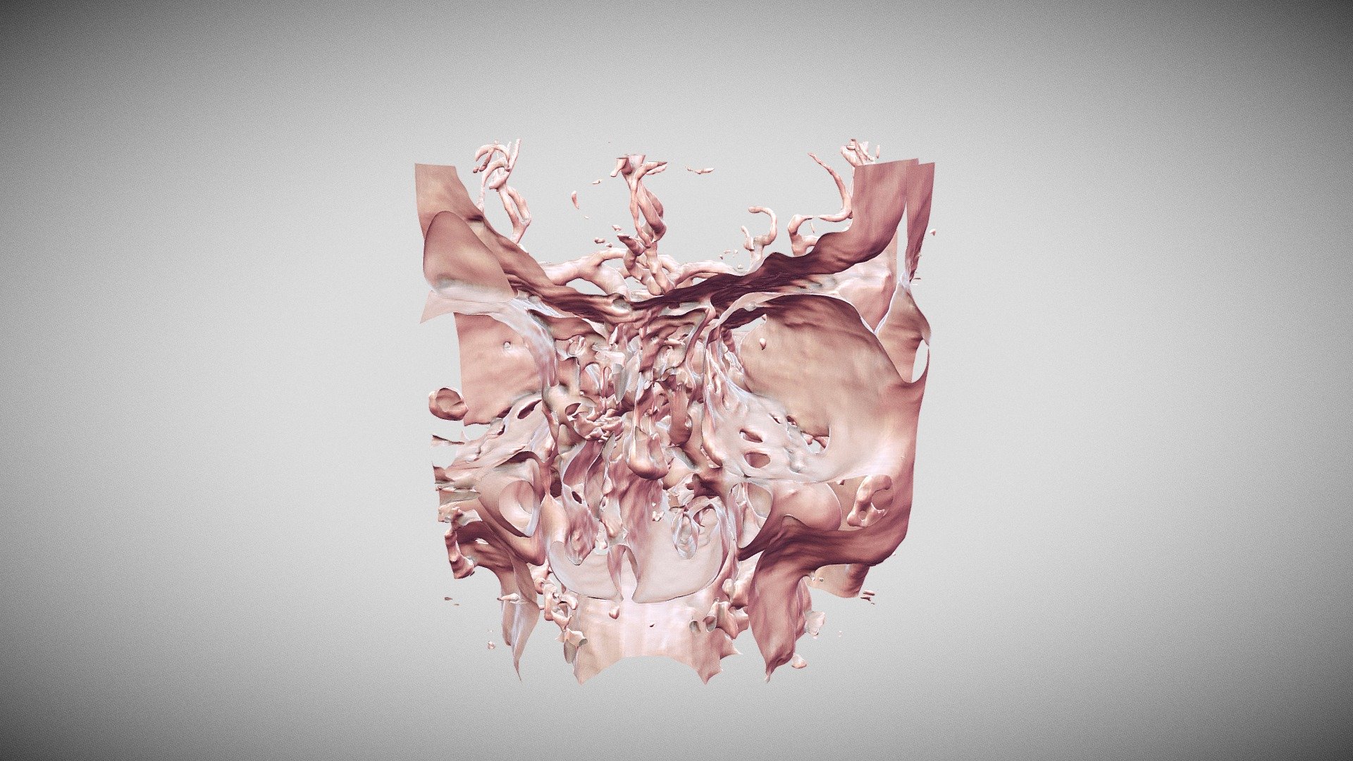 Adult DSA Head Angio. ACOM aneurysm