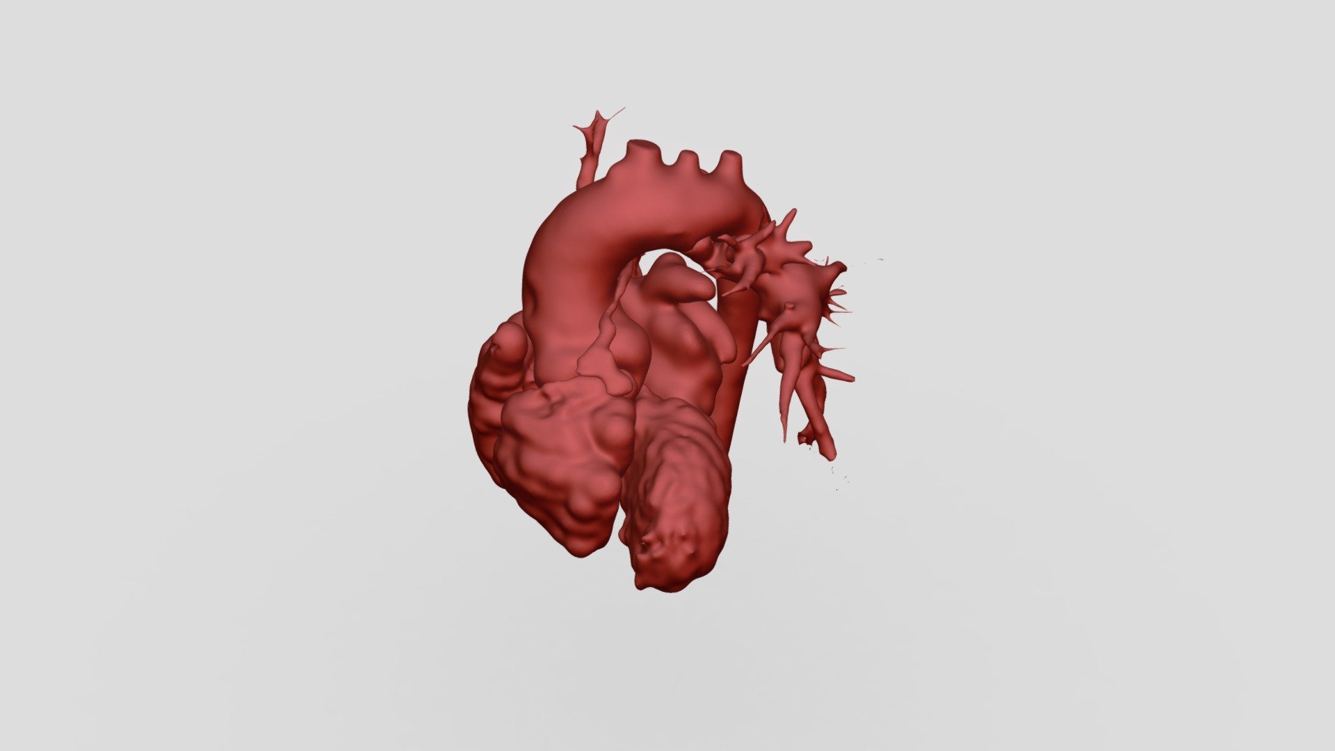 Pulmonary atresia - 3D model by ricardopsr [3b1462f] - Sketchfab