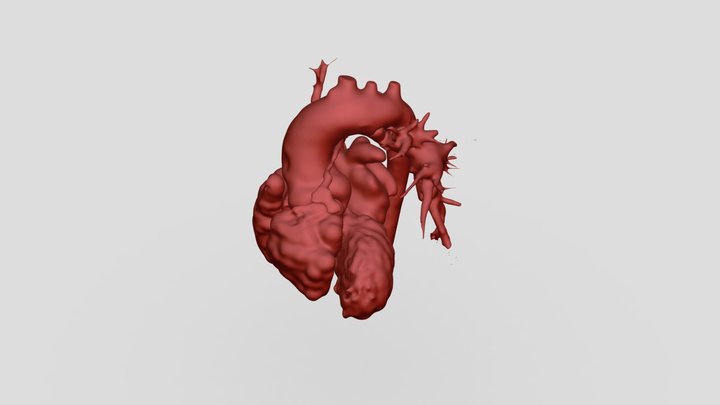 Pulmonary atresia 3D Model